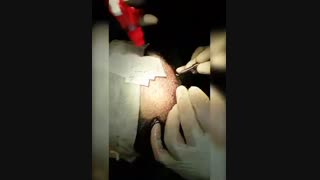کاشت مو - دکتر ابدالی - 22807060