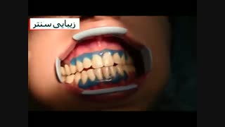 سفید کردن دندان یا بلیچینگ دندان با ژل - دستگاه پیشرفته - زیبایی سنتر جراحی گوش