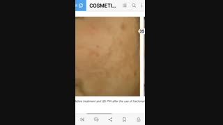 درس سوم .لک پوستی  در سبزه رو ها و رنکین پوستان