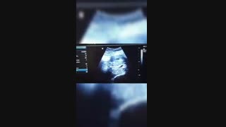 فیلم تشکیل ساک حاملگی