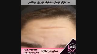 تزریق بوتاکس خطوط اخم و پیشانی
