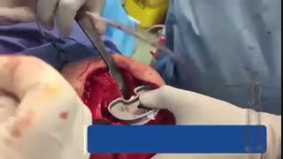 فیلم جراحی تعویض مفصل زانو