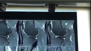 بررسی منیسک زانو در MRI