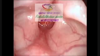 بیماری های حنجره - استروبوسکوپی حنجره |گفتار