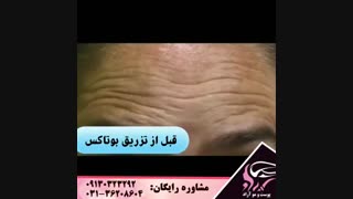 رفع خط اخم و پیشانی با بوتاکس