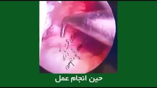 بازسازی رباط صلیبی در مرد جوان ورزشکار