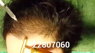 مزوتراپی - 22807060