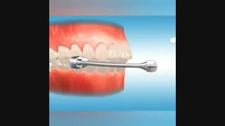 فیلم درمان بیرون زدگی دندانهای فک بالا