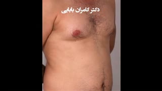 جراحی ژنیکوماستی توسط دکتر کامران بابائی پریودنتیکس