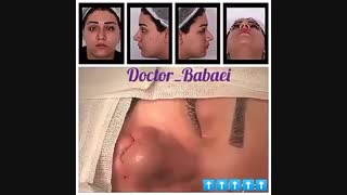 نمونه ی جراحی بینی دکتر کامران بابائی اصلاح طرح لبخند