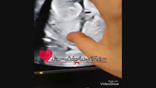 فیلم سونوگرافی شکم جنین