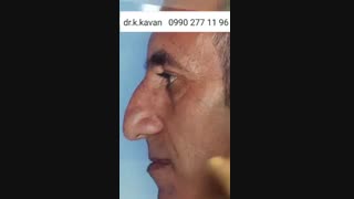 جراحی زیبایی بینی استخوانی و گوشتی توسط دکتر کاوان