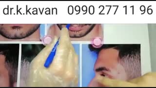 جراحی زیبایی بینی استخوانی و گوشتی توسط دکتر کاوان
