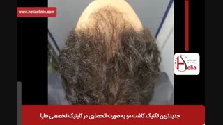 کاشت مو | فیلم کاشت مو | کلینیک پوست و مو هلیا | شماره 2