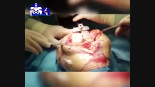 هدف از جراحی تعویض مفصل زانو چیست؟