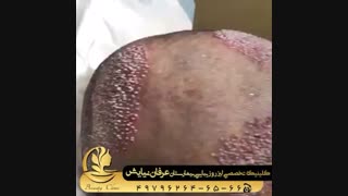 فیلم کاشت مو