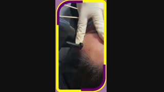 بهترین راه برداشتن خال های صورت