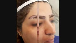 مناسب ترین روش کاشت ابرو
